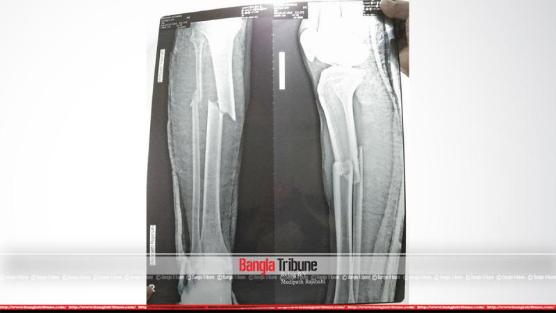 X-Ray film of Tarikul`s Leg examined on Friday (July 06).