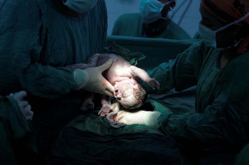 FILE PHOTO: A baby is delivered through a Caesarean section in the labour and delivery unit at the Escuela hospital in Tegucigalpa September 3, 2013. REUTERS