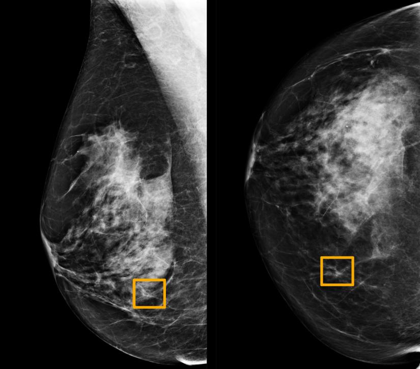 A yellow box indicates where an artificial intelligence (AI) system found cancer hiding inside breast tissue, in an undated photo released by Northwestern University in Chicago January 1, 2020. Northwestern University/Handout via REUTERS.